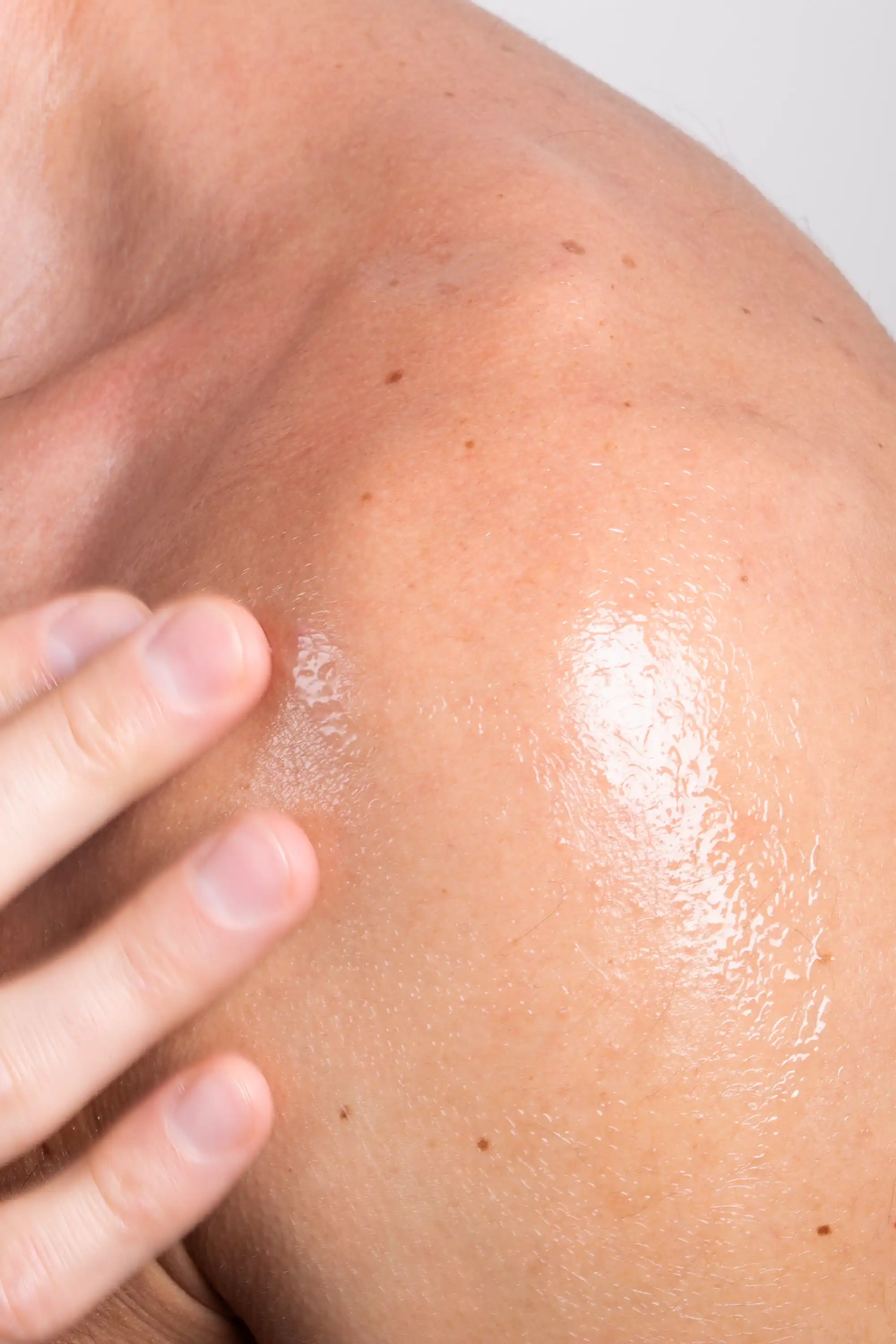 Blemicalm Body Skin Clearing Spray - Image 6